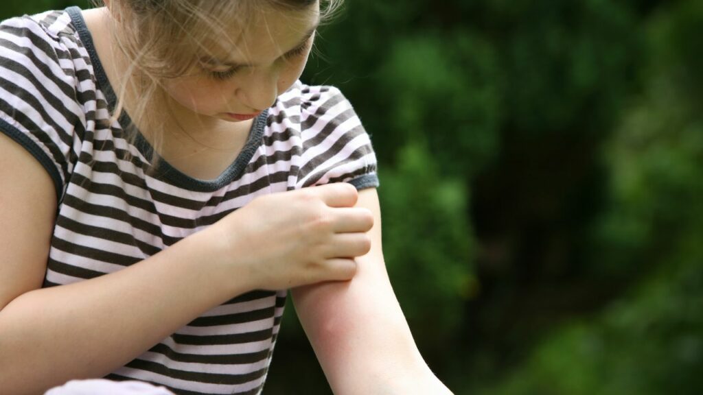 West Nile, i sintomi e come prevenire la febbre virale trasmessa dalla zanzara Vanity Fair Italia